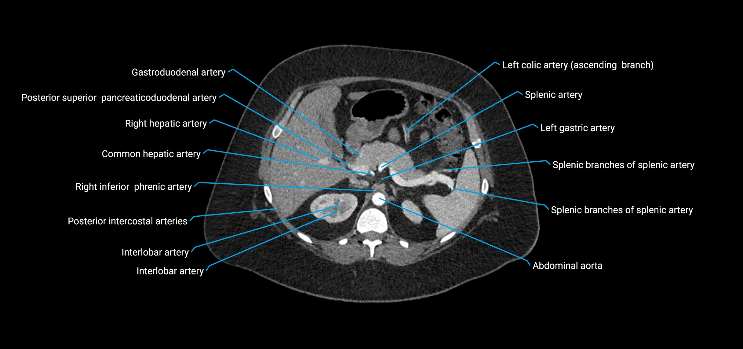 CTA abdomen axial cross sectional anatomy labelled image_50 (2).webp